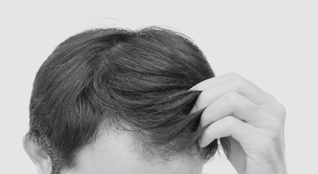 male hair transplant houston