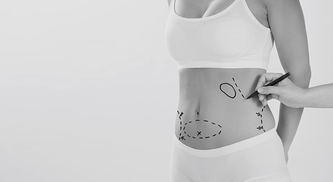 fat removal liposuction procedure